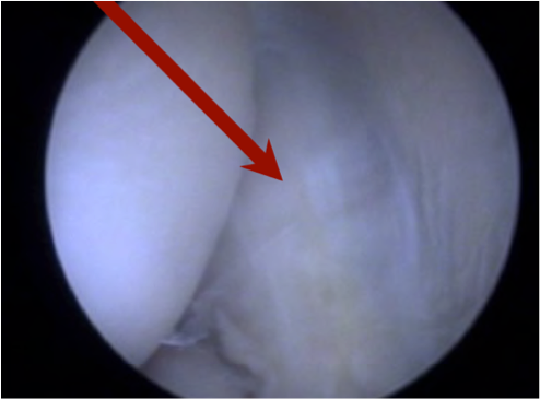 Vue arthroscopique à l’intérieur du coude, une flèche rouge désigne une zone tendineuse