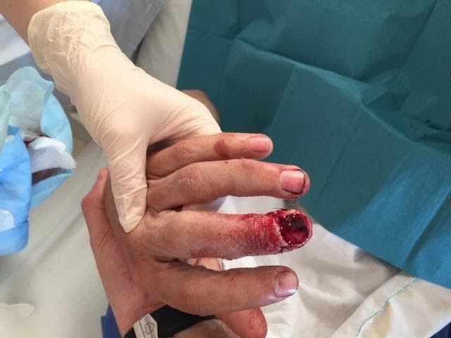 Photographie aux urgences d’une main, plaie sanglante avec perte de substance à l’extrémité d’un doigt