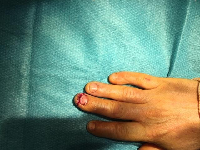 Photographie clinique d’un doigt sur champ opératoire, plaie de la pulpe et de l’extrémité