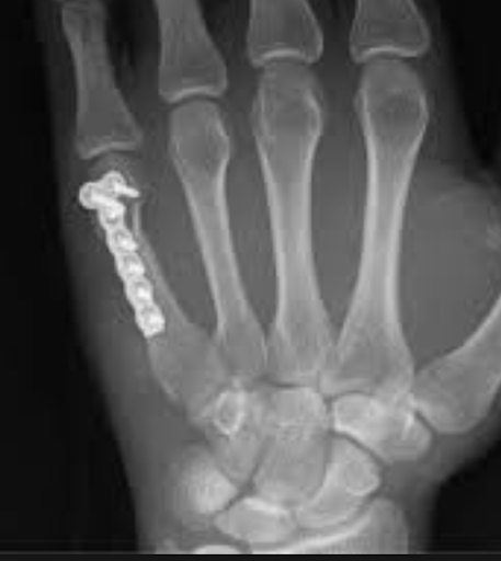 Radiographie de la main de face, plaque vissée fixant la diaphyse du cinquième métacarpien