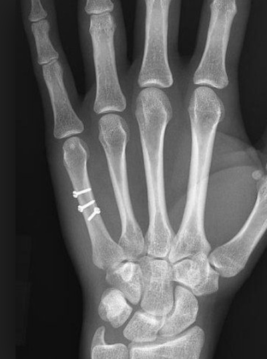 Radiographie de la main de face, deux vis en place sur le cinquième métacarpien