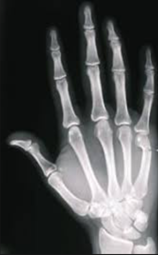 Radiographie de la main de face, fracture du col du cinquième métacarpien avec bascule