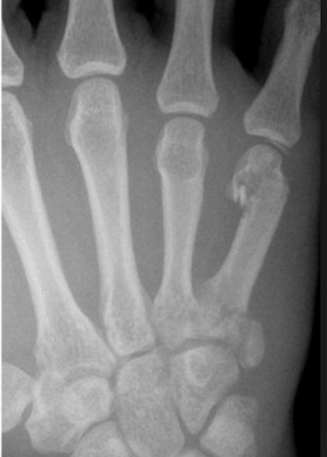 Radiographie centrée sur le cinquième métacarpien, fracture déplacée et fragmentée de son extrémité distale
