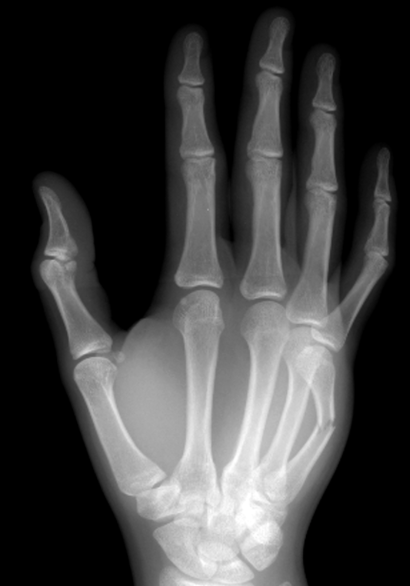 Radiographie de la main de face, trait de fracture oblique sur la diaphyse du cinquième métacarpien