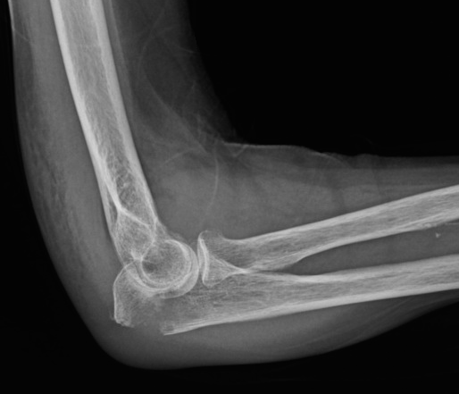 Radiographie du coude de profil montrant l’olécrane et l’articulation entre humérus, radius et ulna