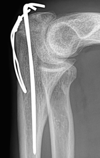 Radiographie du coude de profil après ostéosynthèse de l’olécrane par deux broches et un cerclage métallique