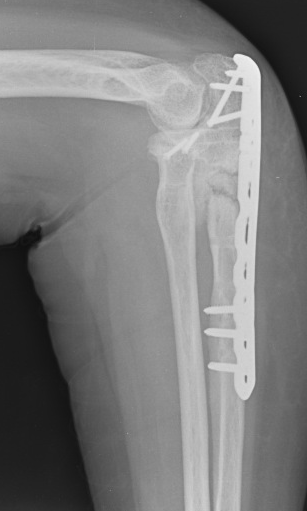 Radiographie du coude après ostéosynthèse de l’olécrane par une plaque vissée sur l’ulna