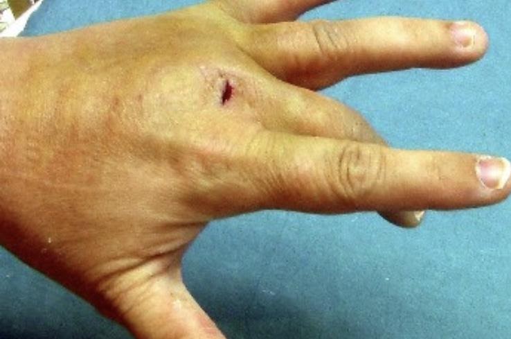 Photographie du dos de la main, courte plaie linéaire en regard des tendons extenseurs