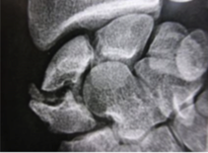 Radiographie centrée sur le poignet montrant les os du carpe et un scaphoïde d’aspect irrégulier