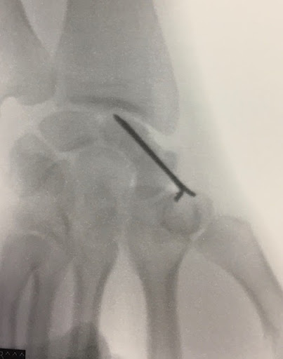 Radiographie du poignet de face avec une vis traversant le scaphoïde après ostéosynthèse